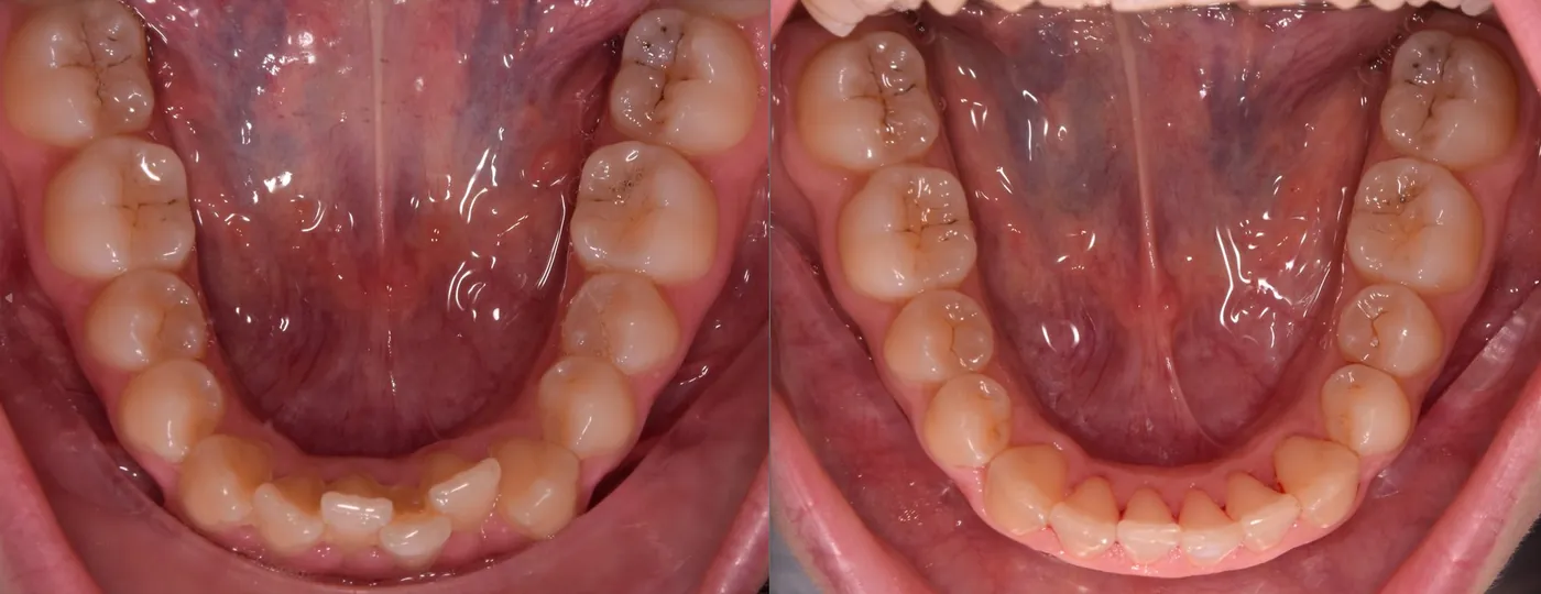 Aligner kezelés előtte-utána