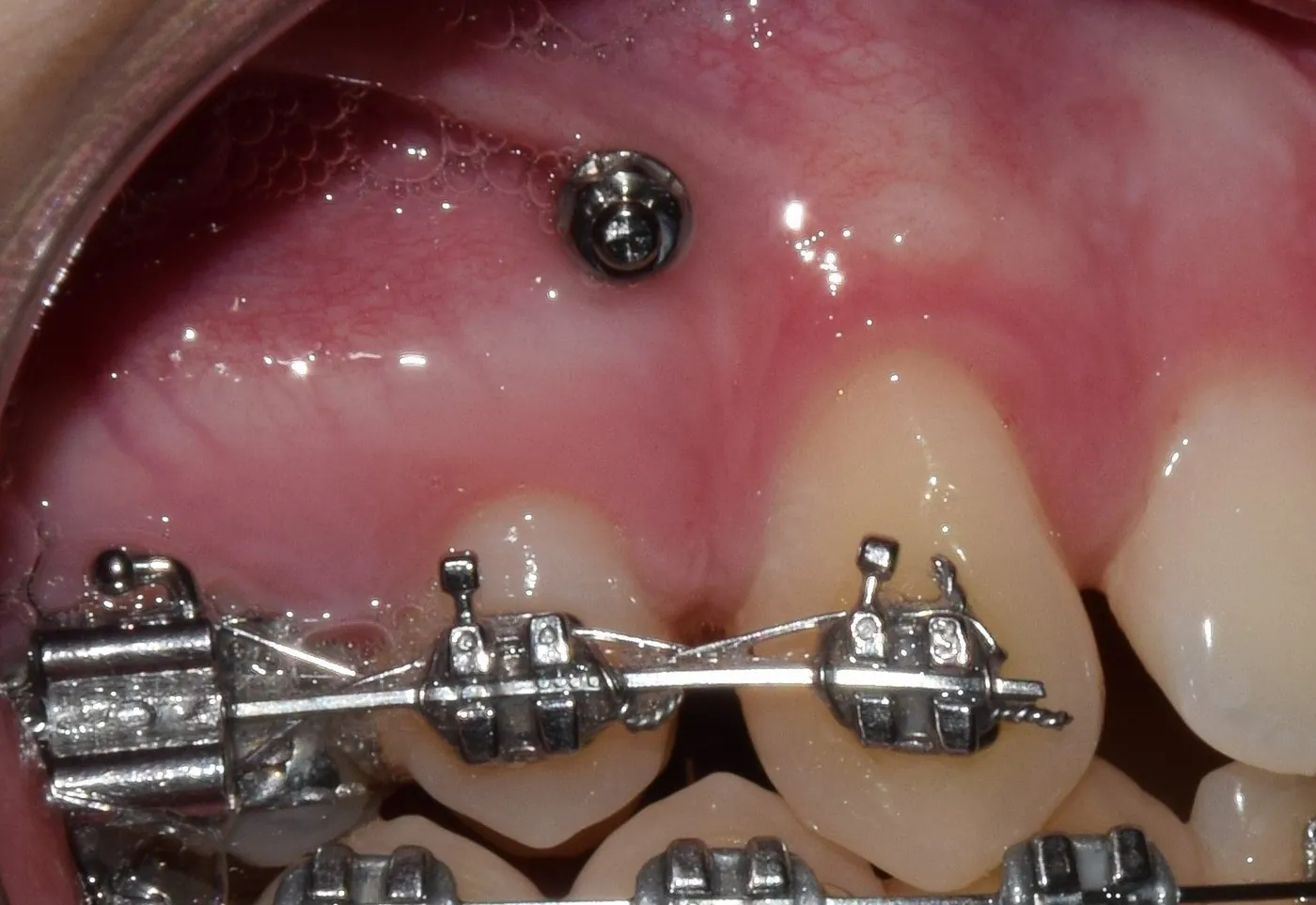 Fogszabályozási miniimplantátum – fogszabályozási fogalom illusztrációja