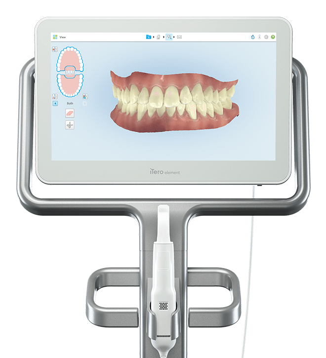 Intraorális scanner – fogszabályozási fogalom illusztrációja